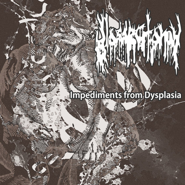 Glossectomy : Impediments From Dysplasia (CD, EP)